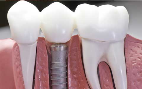 Implantes: la solución definitiva